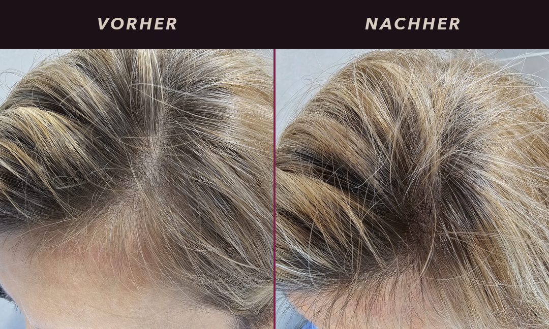 Haarverdichtung am Scheitel bei einer Frau mit blondem Haar: vorher schimmert die Kopfhaut am Oberkopf durch, nachher wirkt der Scheitel sichtbar dichter