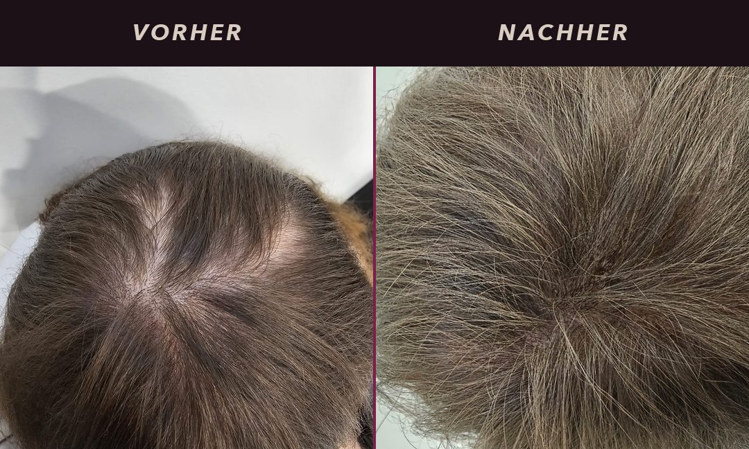 Haarverdichtung am Wirbel bei einer Frau mit braunem Haar: vorher schimmert die Kopfhaut am Oberkopf großflächig durch, nachher wirkt der Wirbel sichtbar geschlossen