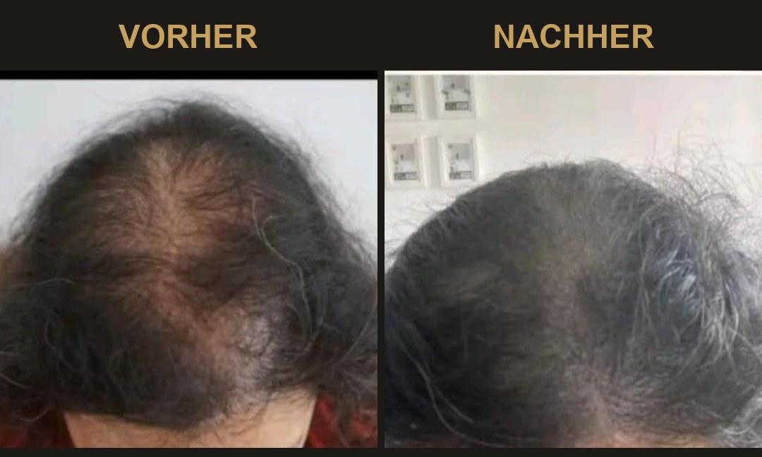 SMP Vorher-Nachher bei Haarverdichtung: sichtbar dichteres Deckhaar nach der Behandlung