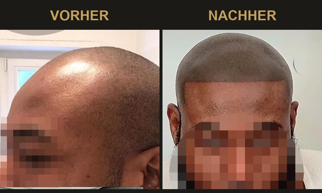 SMP Vorher-Nachher: vorher kahle, spiegelnde Kopfhaut – nachher gleichmäßige Dichte mit definierter Haarlinie